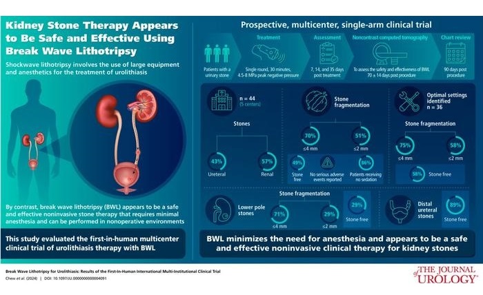 Imagen: Resumen visual del artículo “Litotricia de onda explosiva para litiasis urinaria: resultados del primer ensayo clínico multiinstitucional internacional en humanos” (Foto cortesía de Journal of Urology)